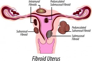 brown and tumor and fibroids